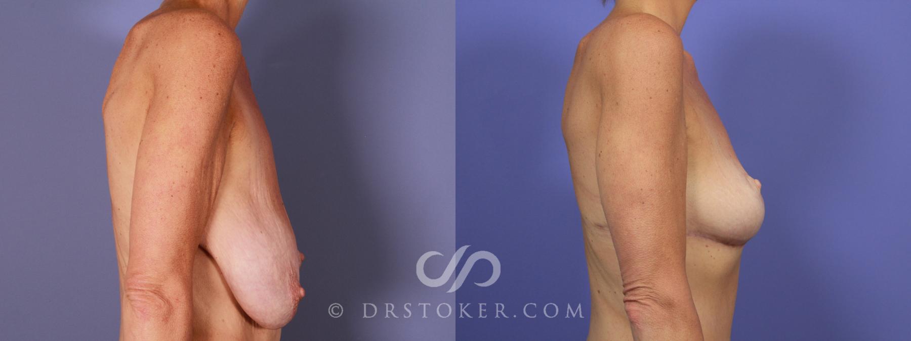 Before & After Breast Lift Case 945 View #3 View in Los Angeles, CA
