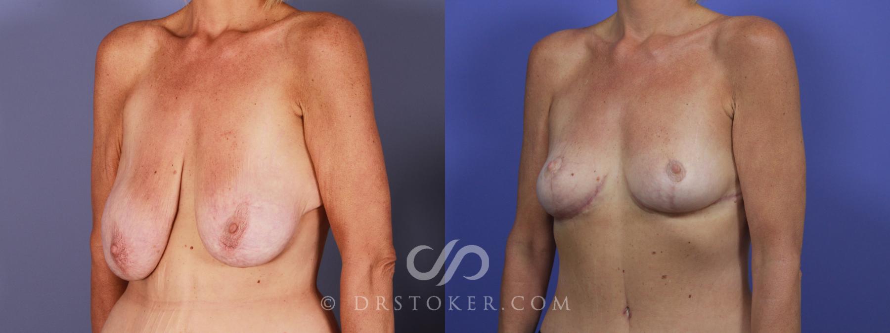 Before & After Breast Lift Case 945 View #4 View in Los Angeles, CA
