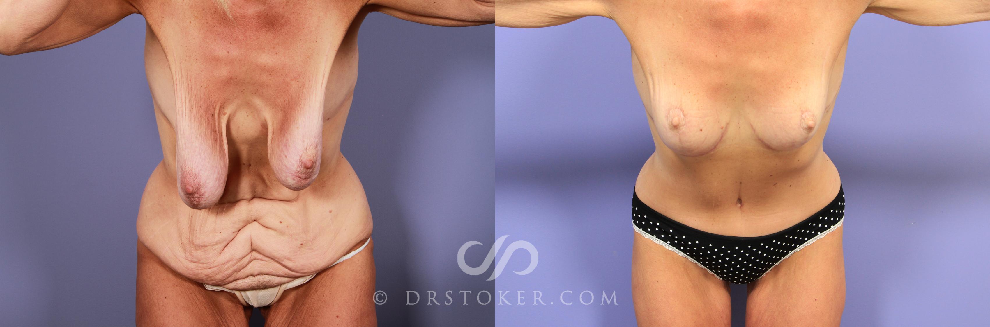 Before & After Breast Lift Case 946 View #1 View in Los Angeles, CA
