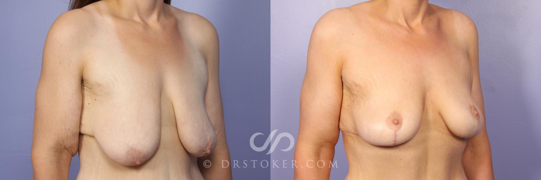 Before & After Breast Lift Case 947 View #2 View in Los Angeles, CA