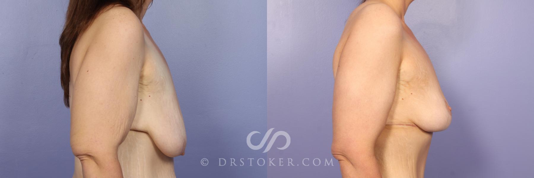 Before & After Breast Lift Case 947 View #3 View in Los Angeles, CA