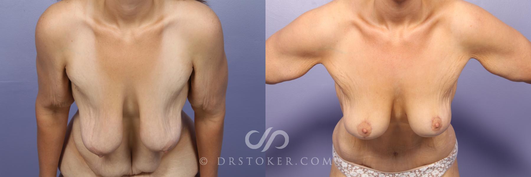 Before & After Breast Lift Case 948 View #1 View in Los Angeles, CA
