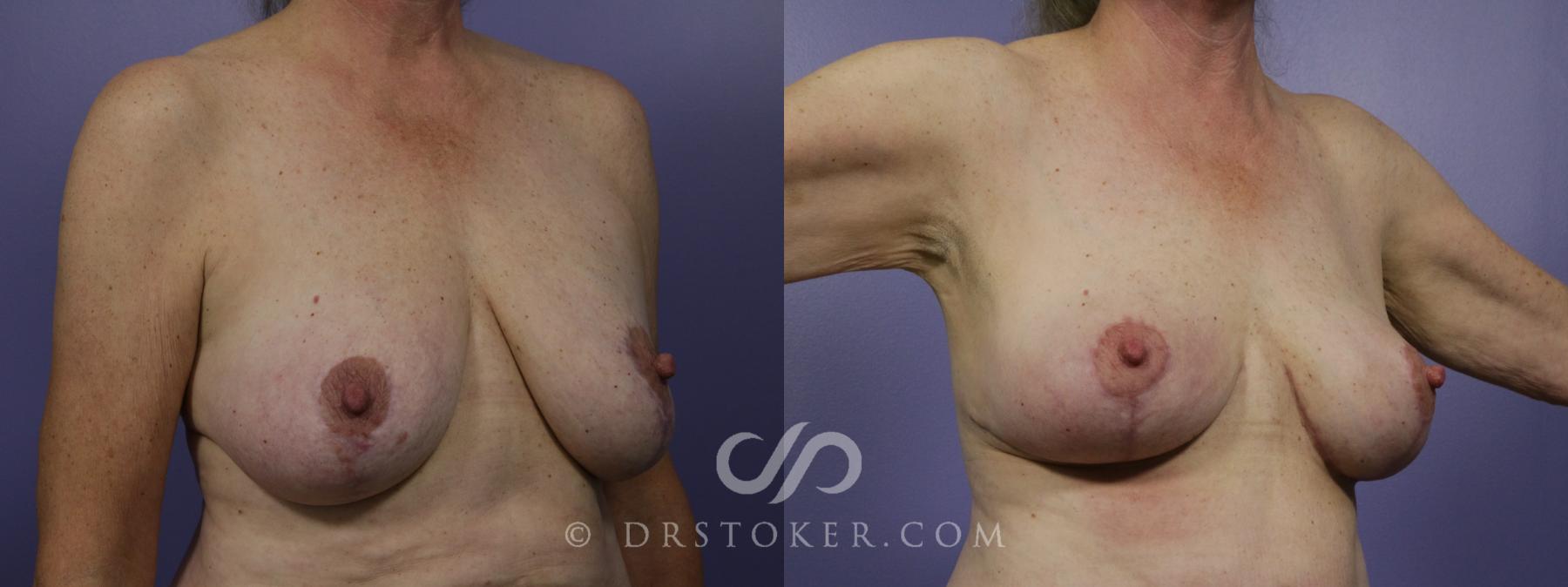 Before & After Breast Lift Case 949 View #2 View in Los Angeles, CA