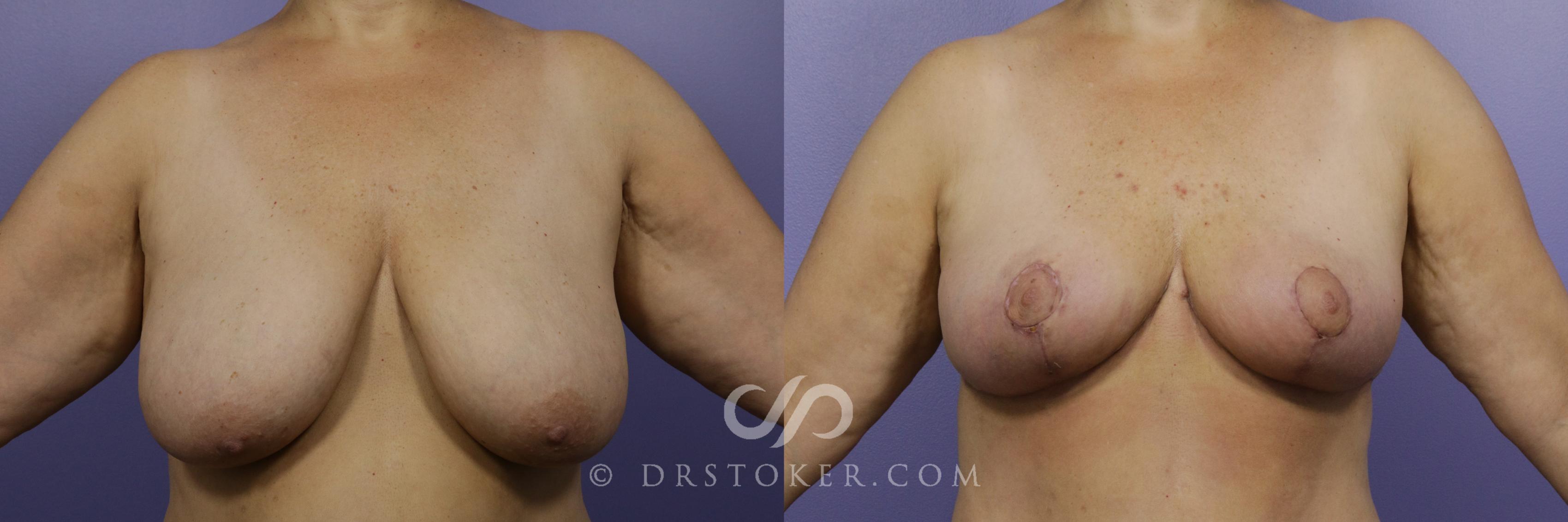 Before & After Breast Implant Correction Case 950 View #1 View in Marina del Rey, CA