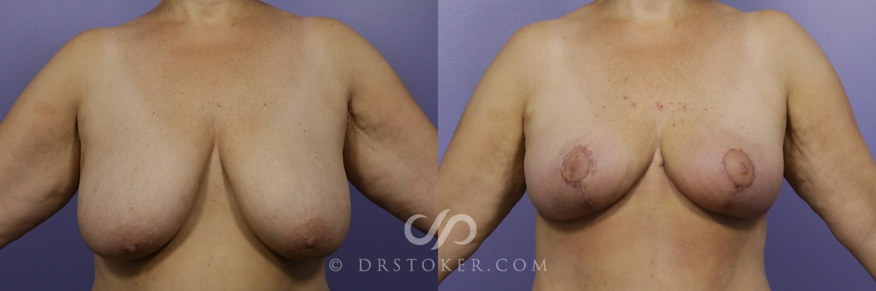 Before & After Breast Implant Correction Case 950 View #1 View in Los Angeles, CA