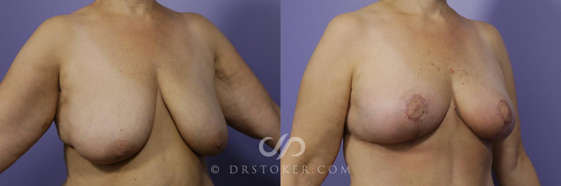Before & After Breast Lift Case 950 View #2 View in Los Angeles, CA