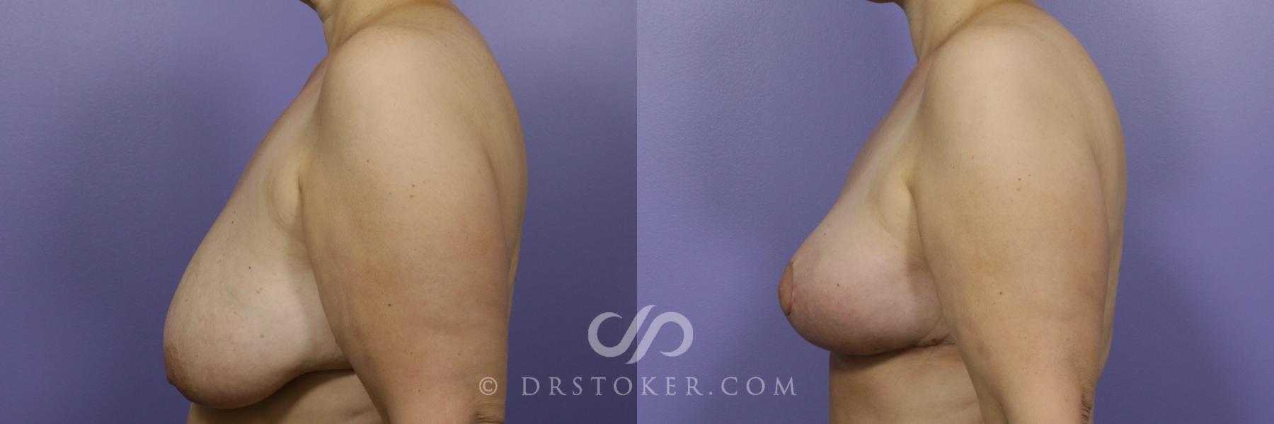 Before & After Breast Lift Case 950 View #4 View in Los Angeles, CA