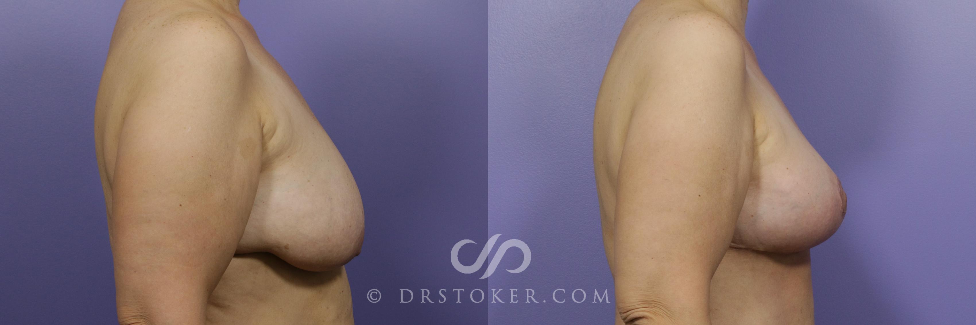 Before & After Breast Lift Case 950 View #5 View in Los Angeles, CA