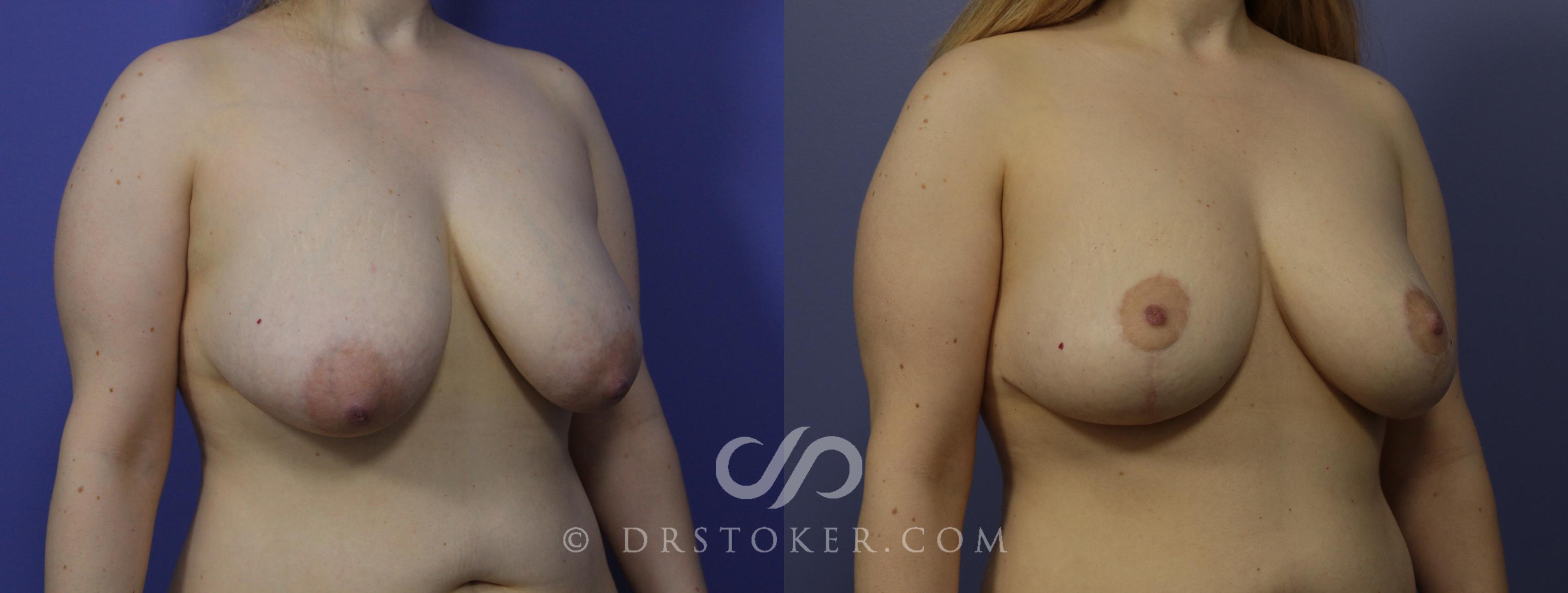 Before & After Breast Lift Case 952 View #2 View in Los Angeles, CA