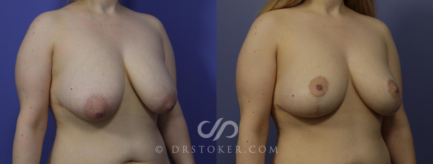 Before & After Breast Lift Case 952 View #2 View in Los Angeles, CA