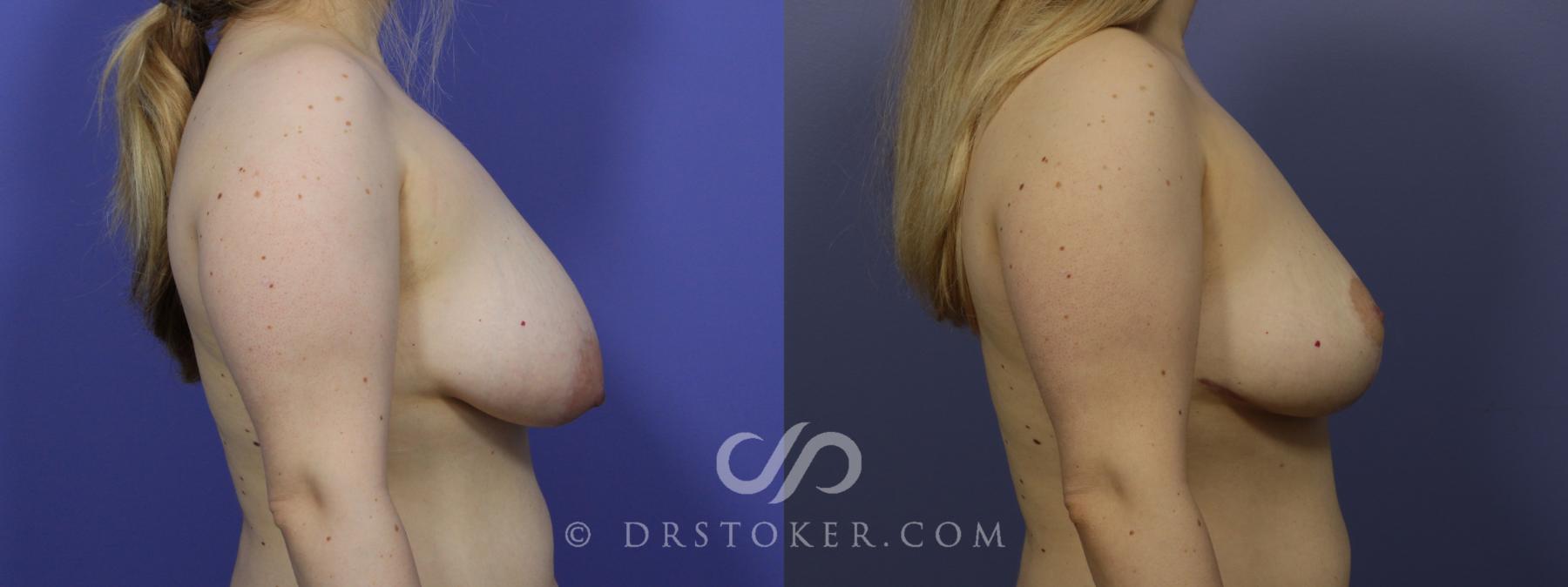 Before & After Breast Lift Case 952 View #4 View in Los Angeles, CA