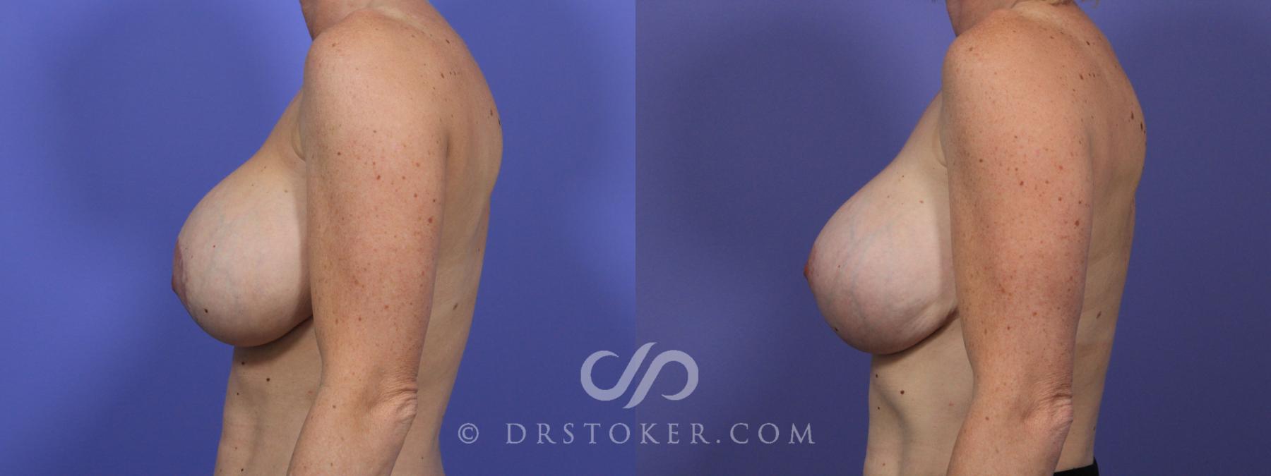Before & After Breast Lift Case 954 View #2 View in Los Angeles, CA