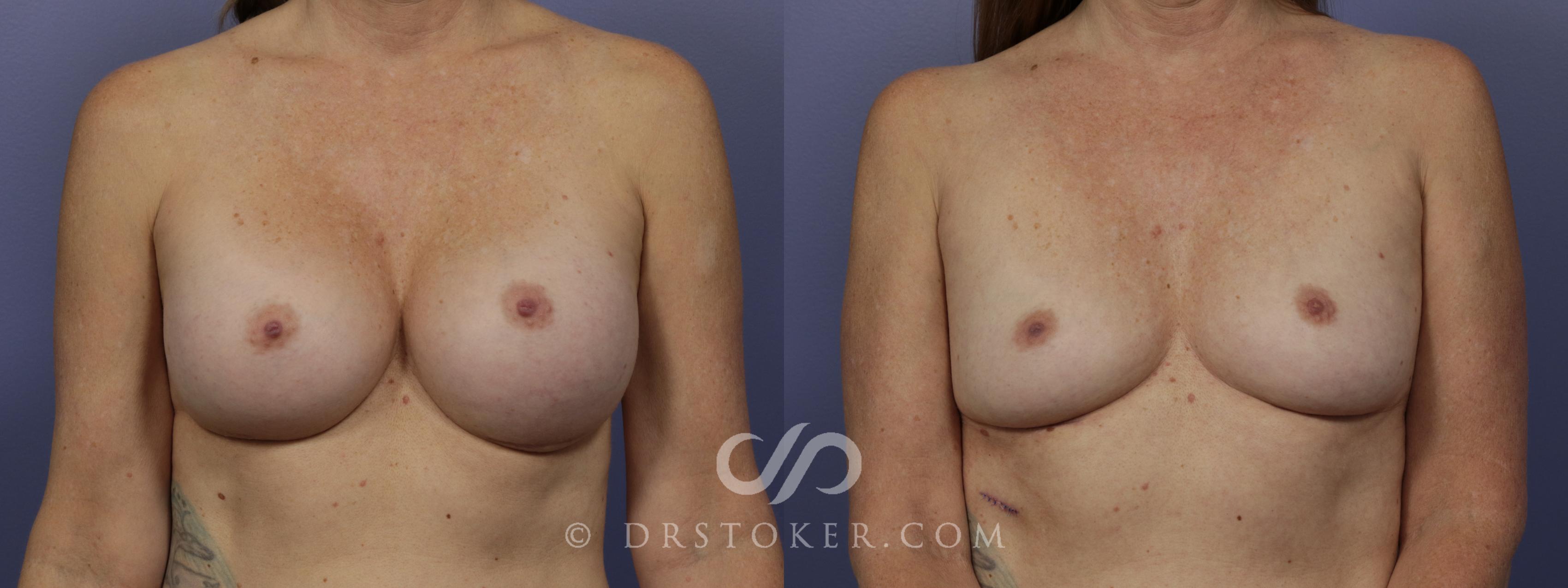 Before & After Breast Implant Removal Case 956 View #1 View in Marina del Rey, CA