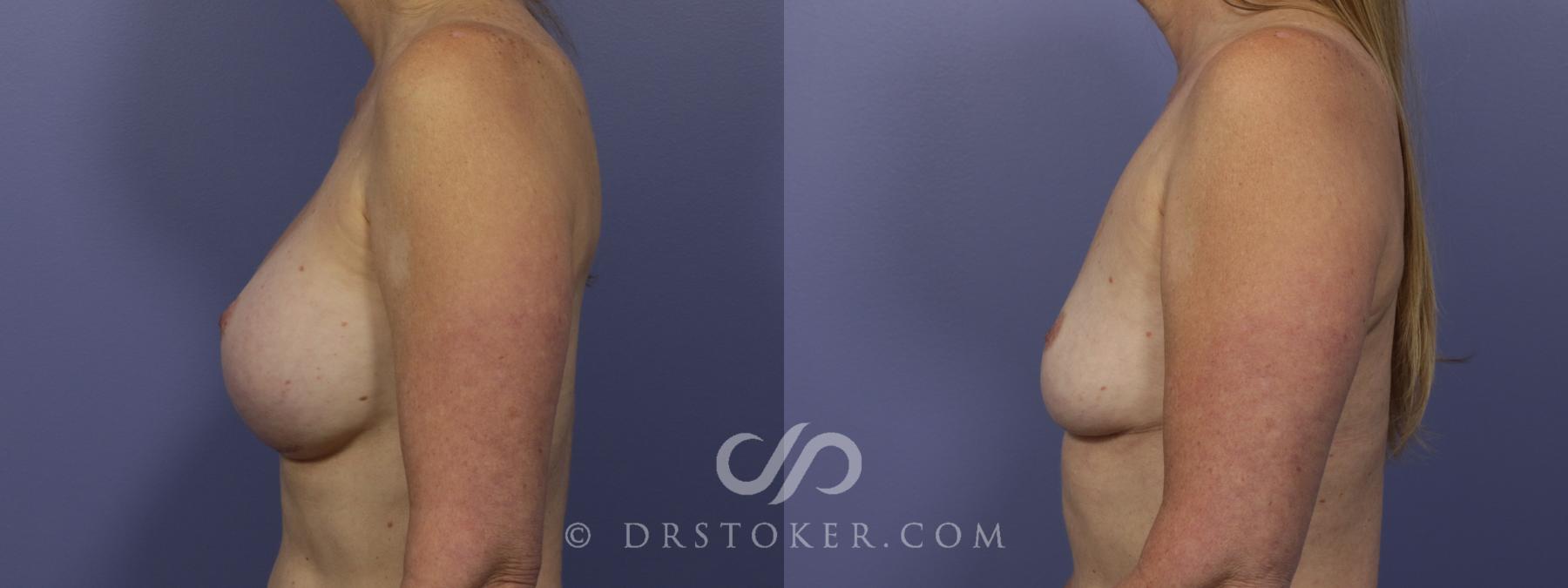 Before & After Breast Implant Removal Case 956 View #2 View in Los Angeles, CA