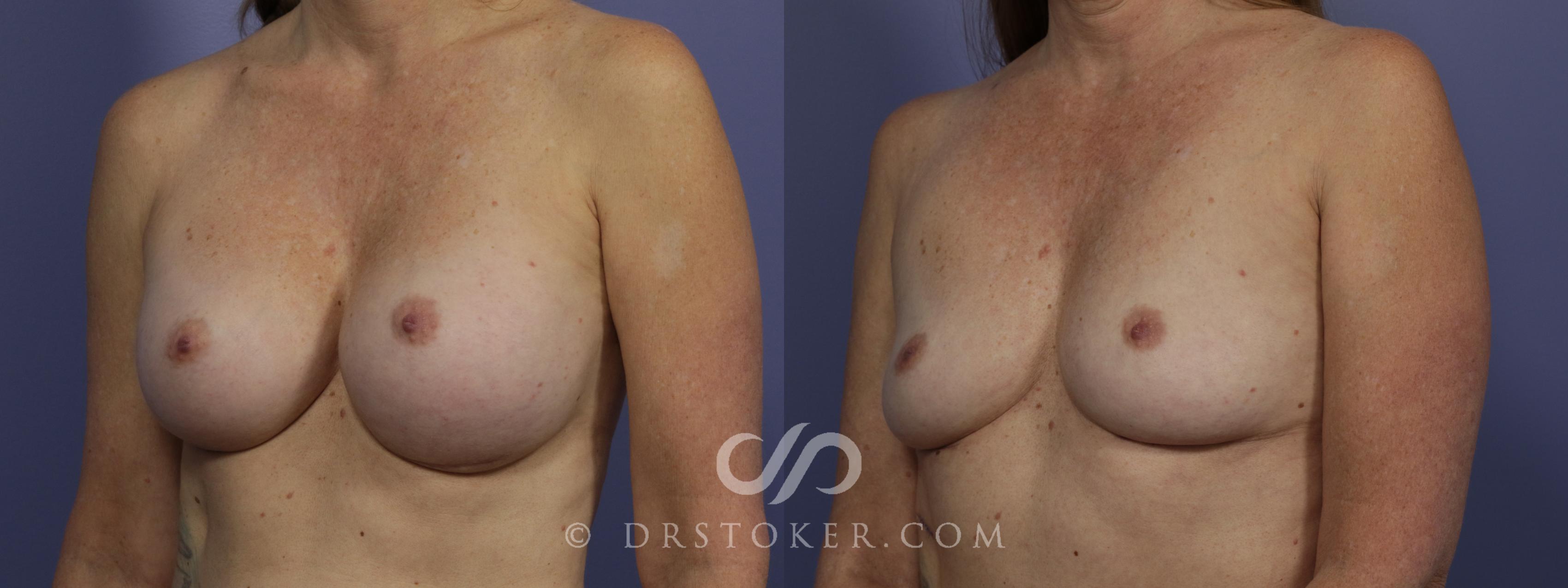 Before & After Breast Lift Case 956 View #3 View in Los Angeles, CA