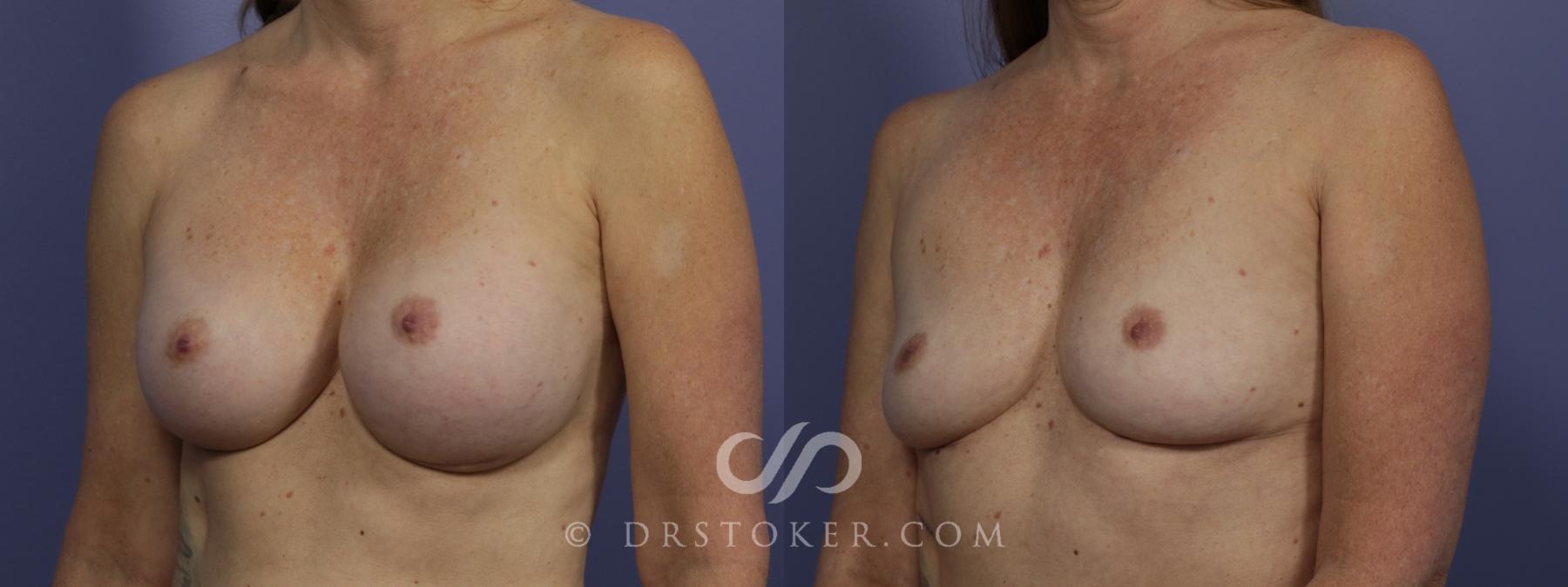 Before & After Breast Implant Removal Case 956 View #3 View in Los Angeles, CA