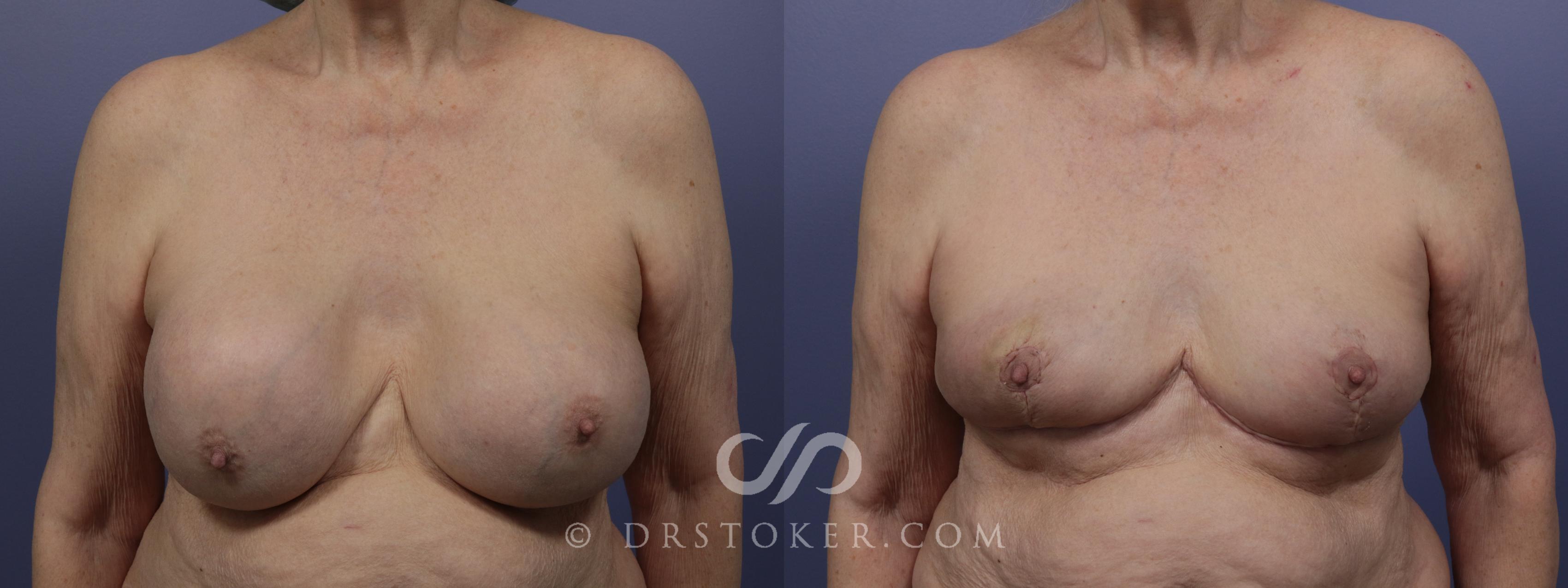 Before & After Breast Lift Case 957 View #1 View in Los Angeles, CA