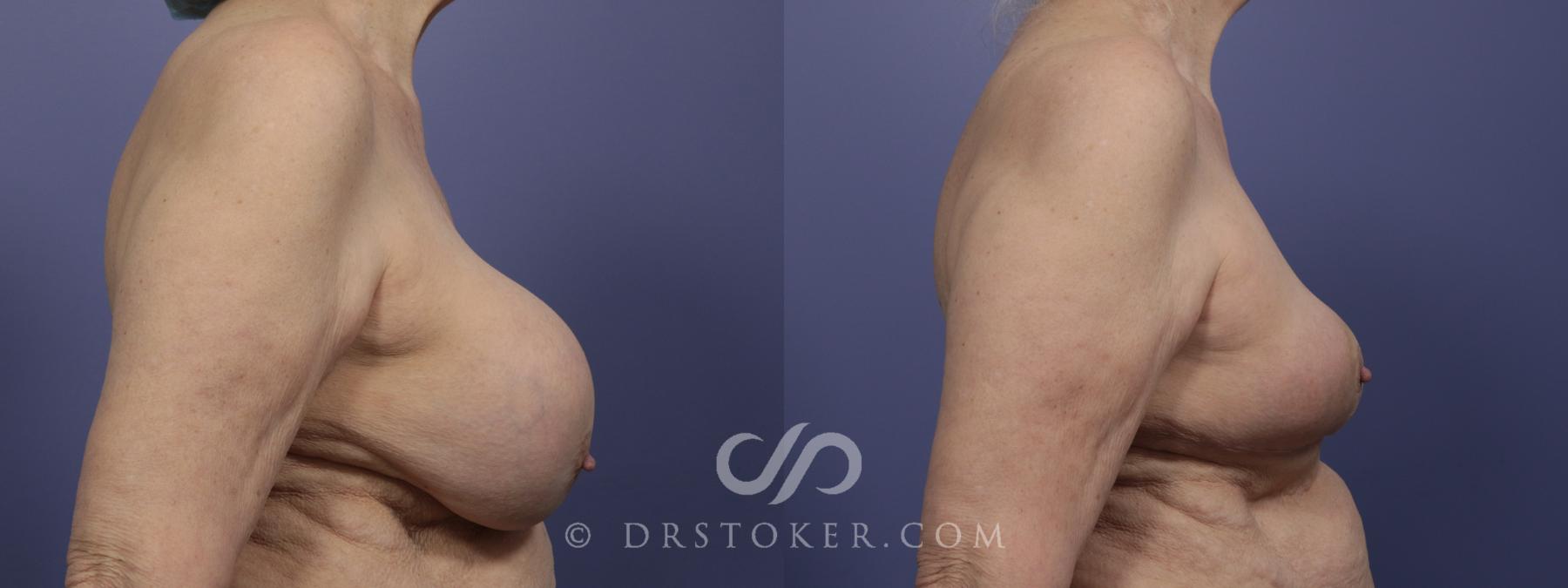 Before & After Breast Lift Case 957 View #2 View in Los Angeles, CA