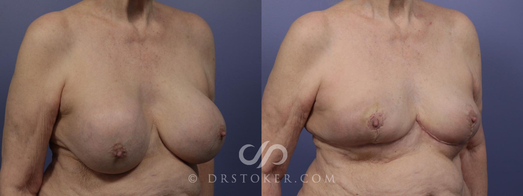 Before & After Breast Lift Case 957 View #4 View in Los Angeles, CA