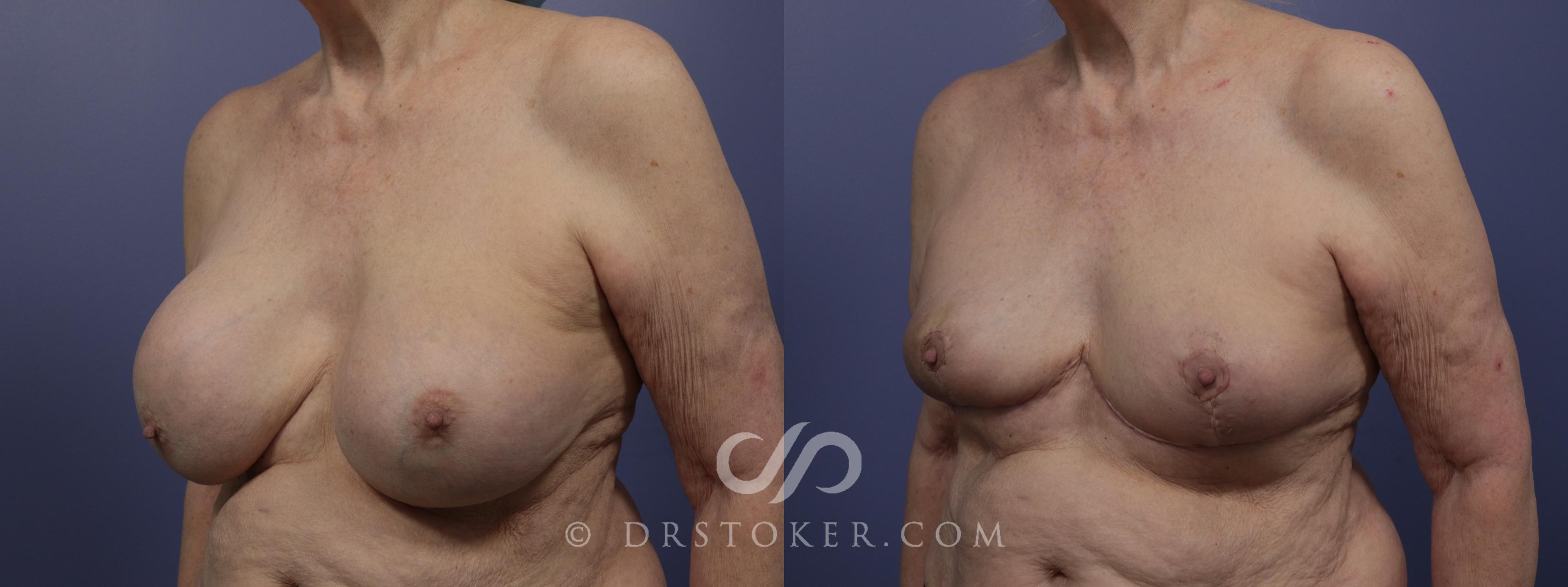 Before & After Breast Lift Case 957 View #5 View in Los Angeles, CA