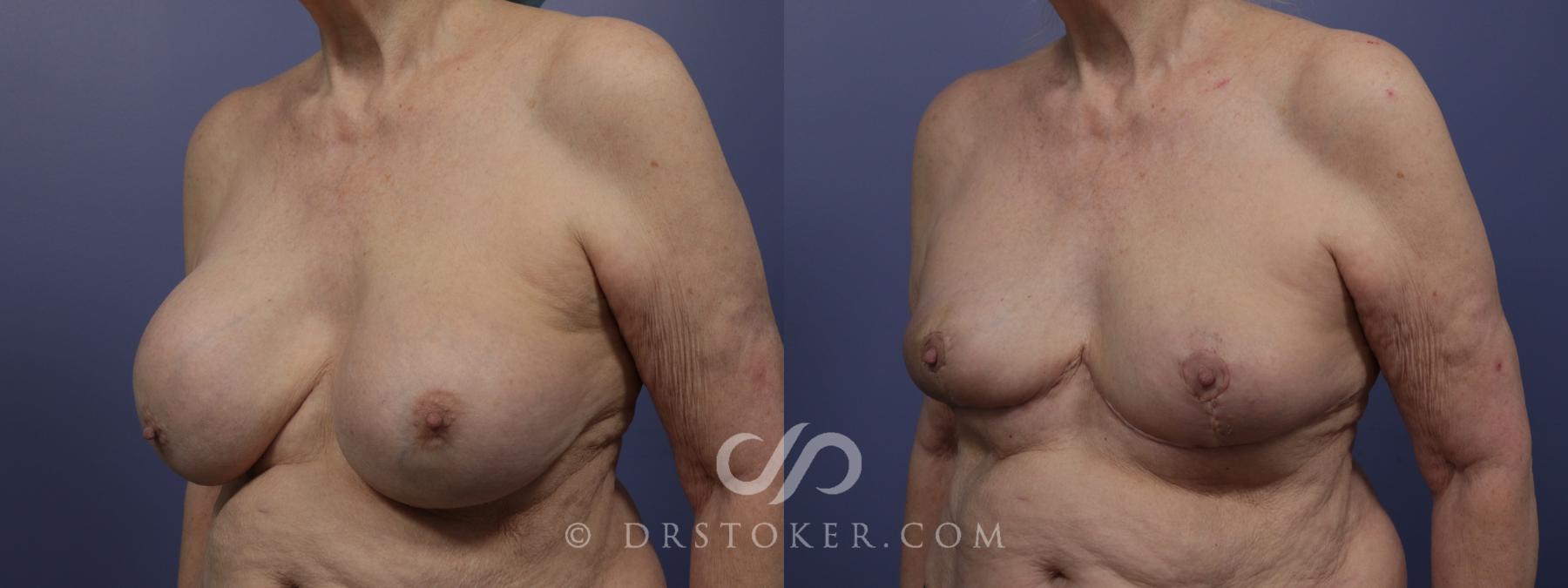Before & After Breast Lift Case 957 View #5 View in Los Angeles, CA