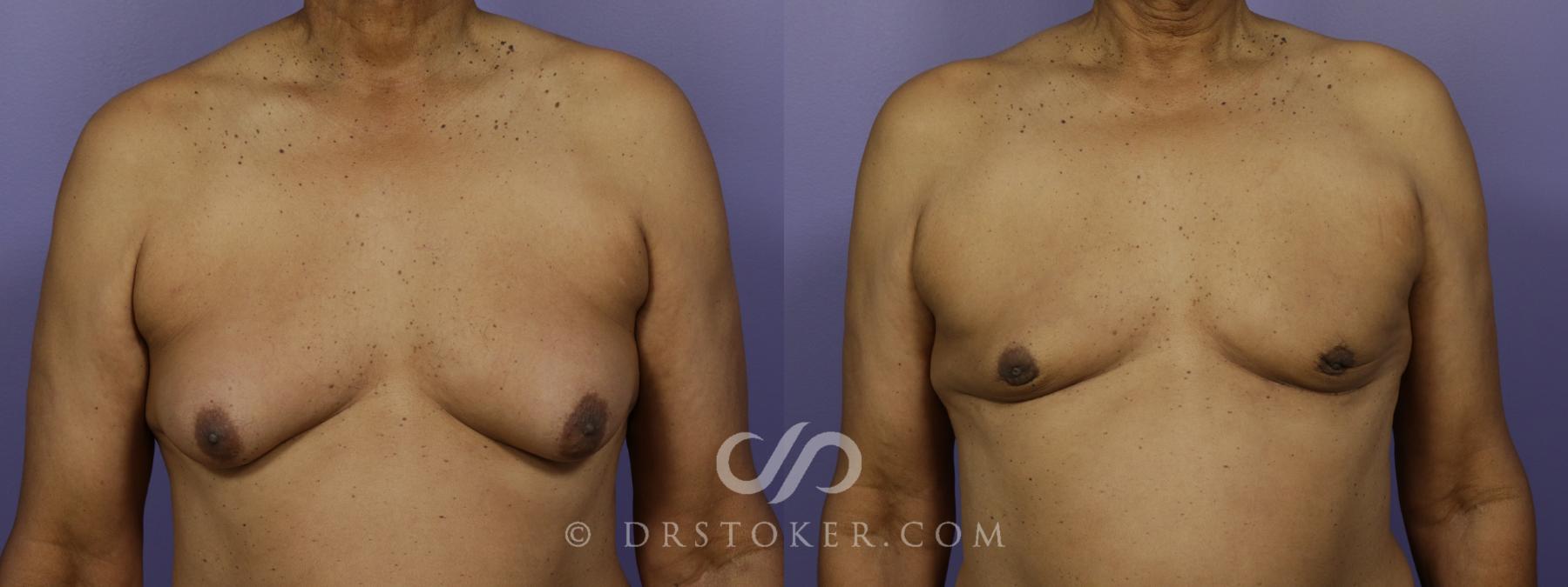 Before & After Breast Reduction for Men (Gynecomastia) Case 1281 View #1 View in Los Angeles, CA