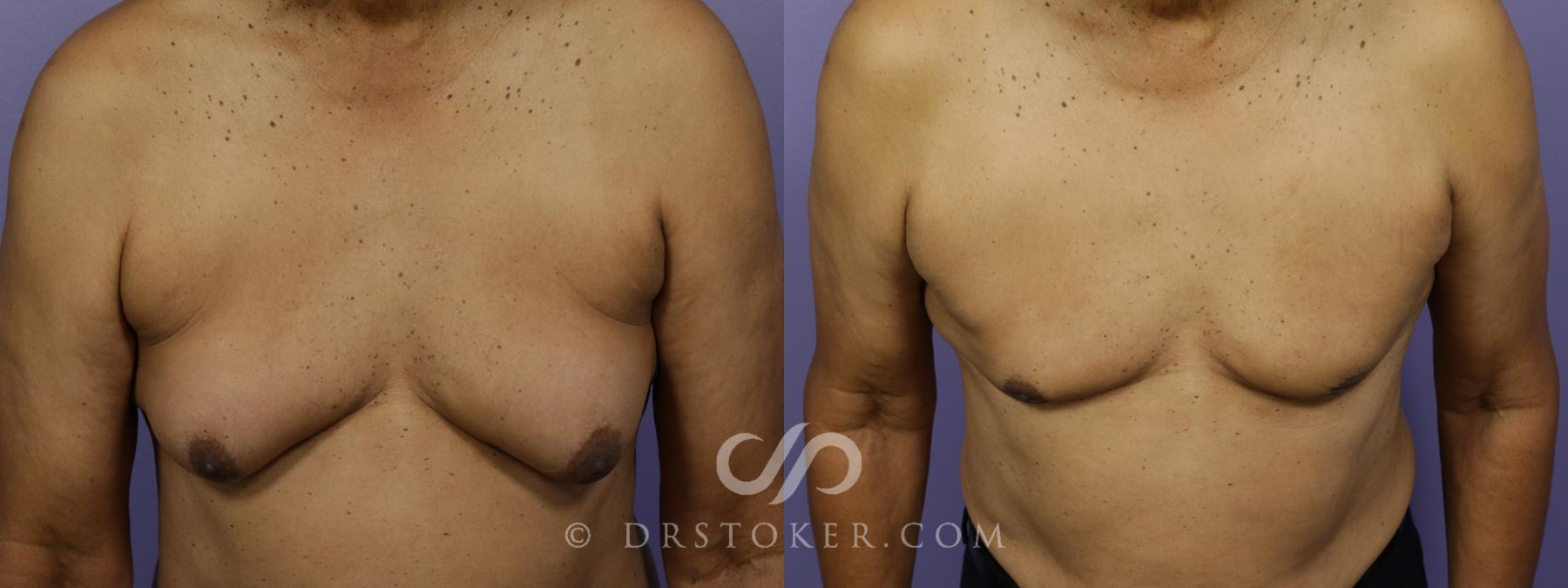 Before & After Breast Reduction for Men (Gynecomastia) Case 1281 View #2 View in Los Angeles, CA