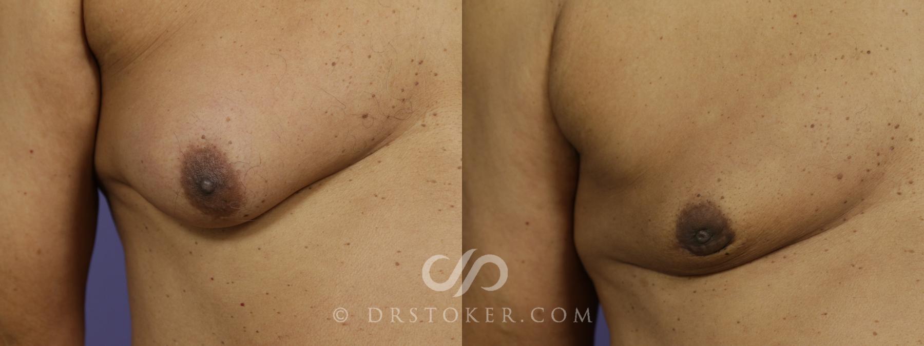 Before & After Breast Reduction for Men (Gynecomastia) Case 1281 View #3 View in Los Angeles, CA
