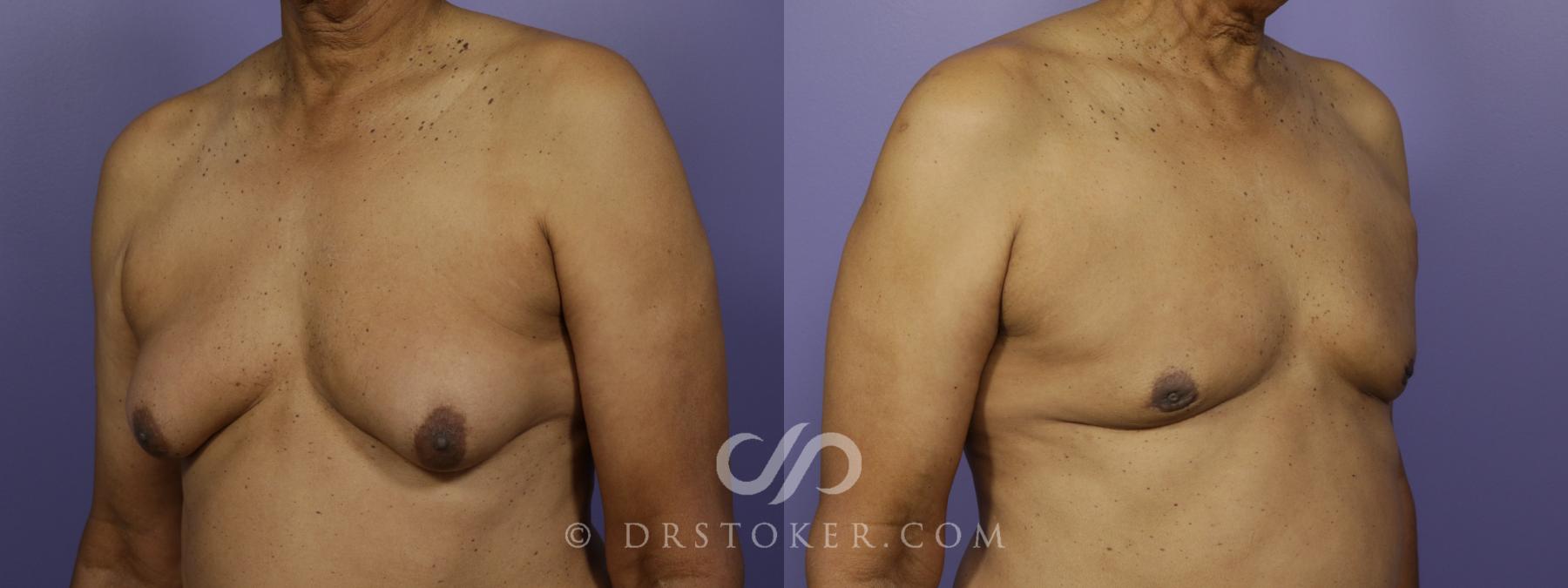 Before & After Breast Reduction for Men (Gynecomastia) Case 1281 View #4 View in Los Angeles, CA