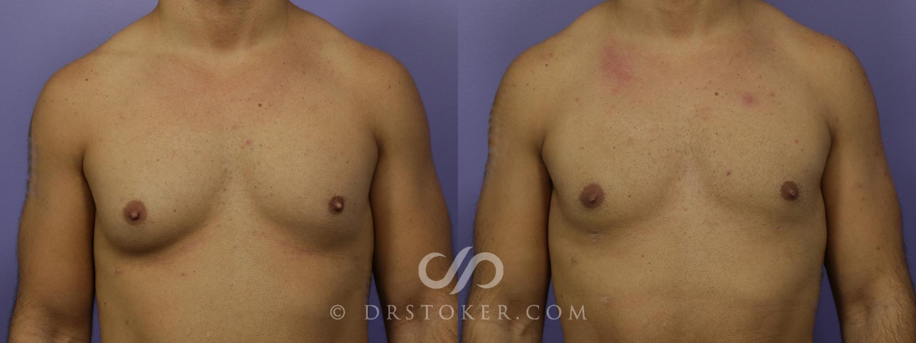 Before & After Breast Reduction for Men (Gynecomastia) Case 1283 View #1 View in Los Angeles, CA