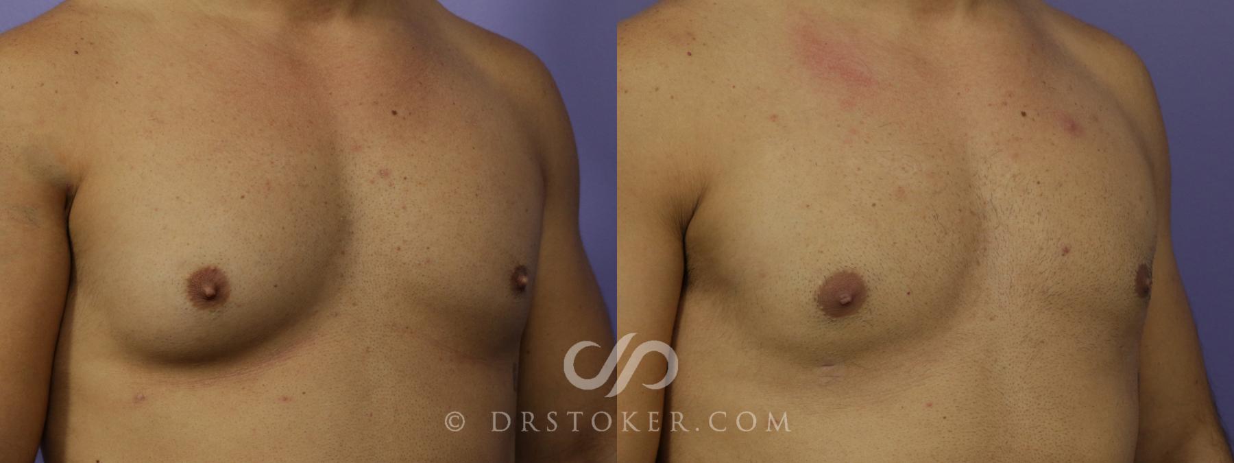 Before & After Breast Reduction for Men (Gynecomastia) Case 1284 View #1 View in Los Angeles, CA