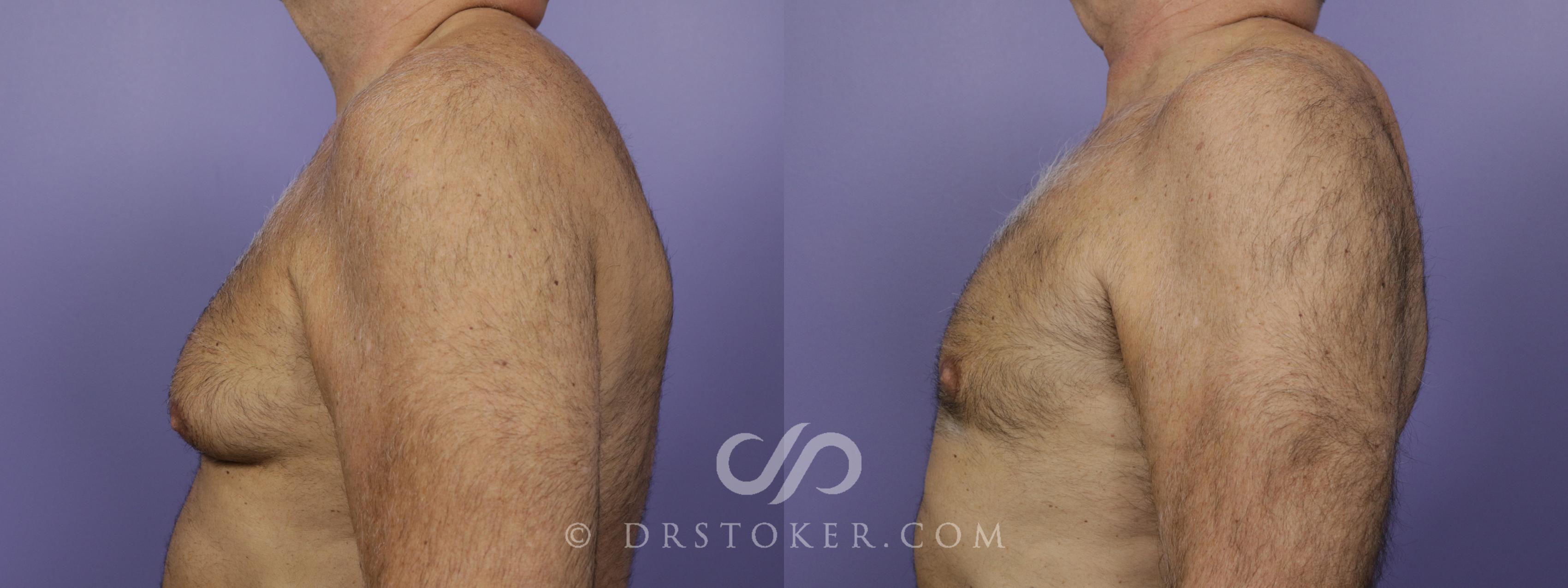 Before & After Breast Reduction for Men (Gynecomastia) Case 1289 View #1 View in Marina del Rey, CA
