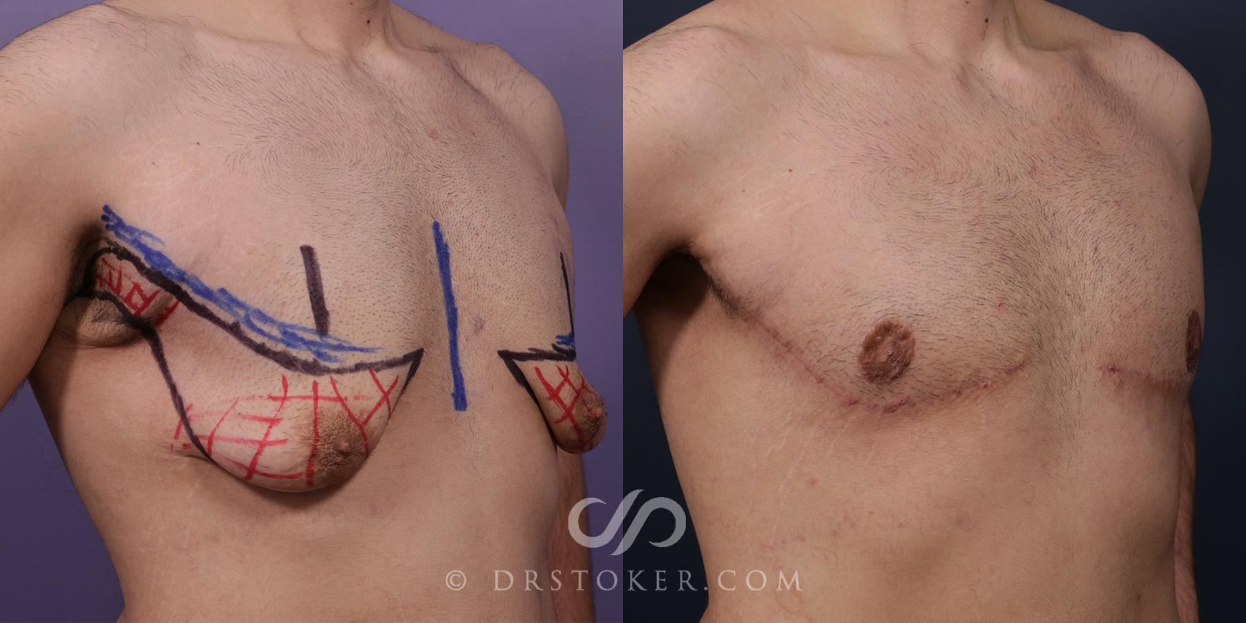 Before & After Breast Reduction for Men (Gynecomastia) Case 1993 Right Oblique View in Los Angeles, CA