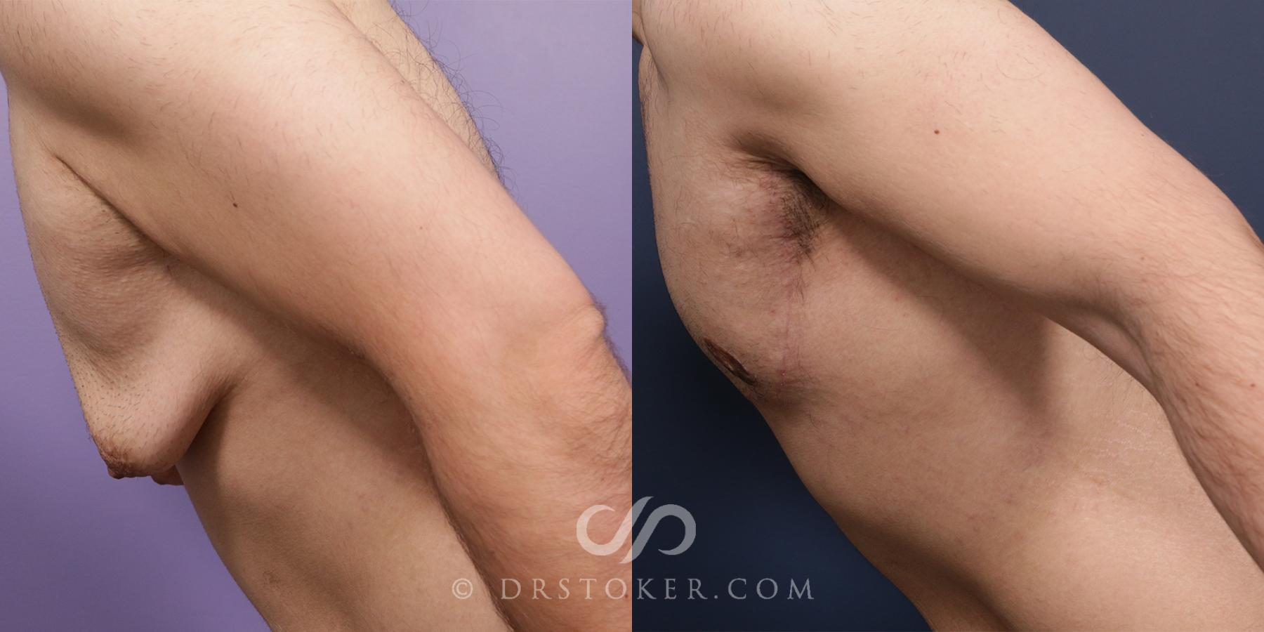 Before & After Breast Reduction for Men (Gynecomastia) Case 1994 Left Side View in Los Angeles, CA