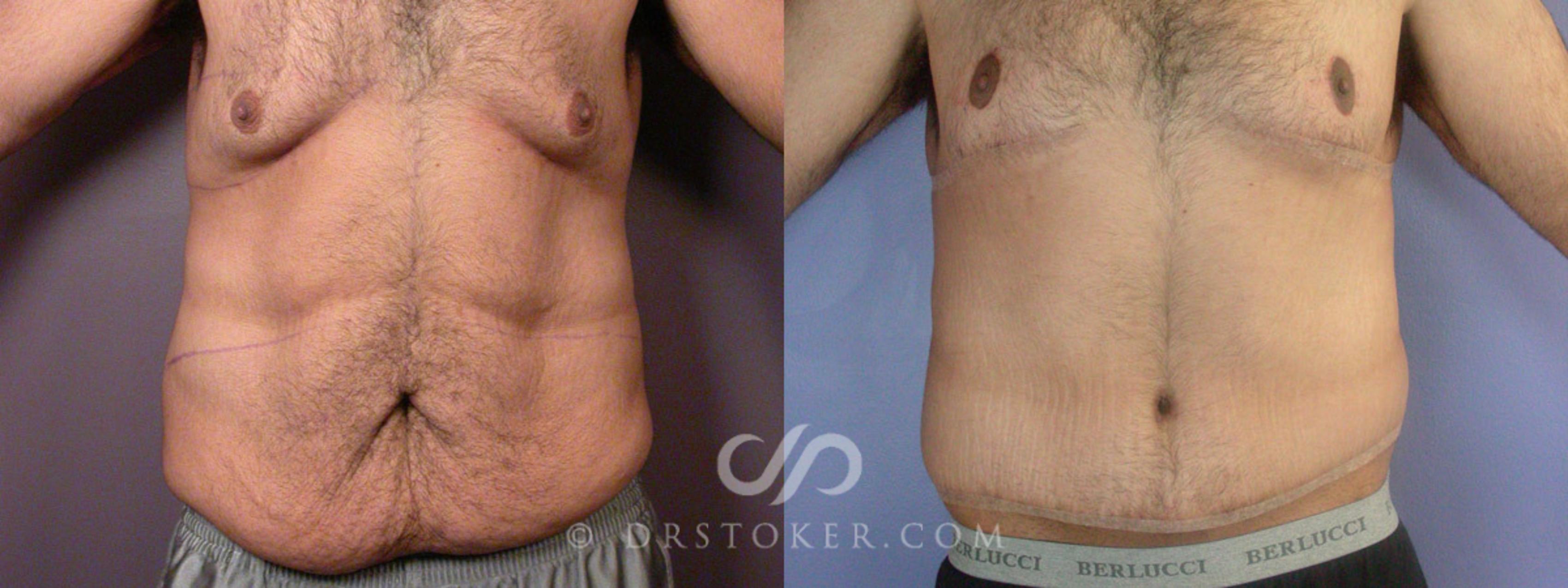 Patient #6023 Male Tummy Tuck (abdominoplasty) Before and After