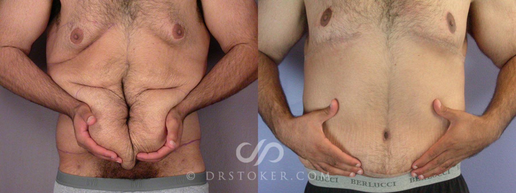 Before & After Body Lift Case 295 View #2 View in Los Angeles, CA