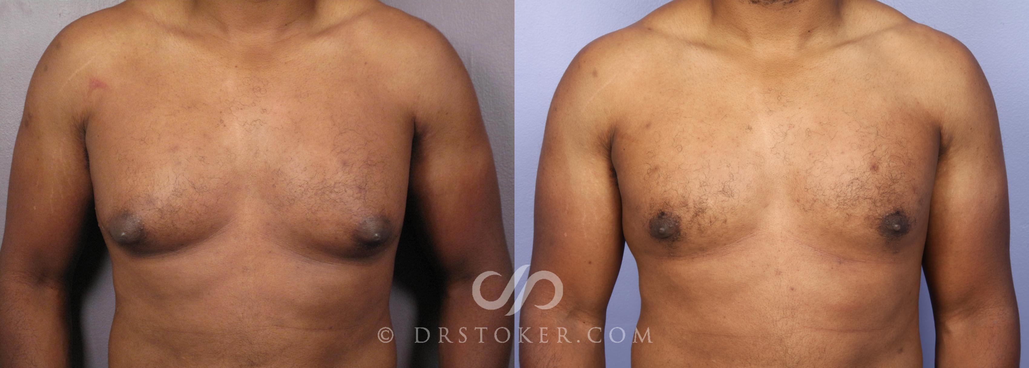 Before & After Breast Reduction (for Men) Case 475 View #1 View in Los Angeles, CA