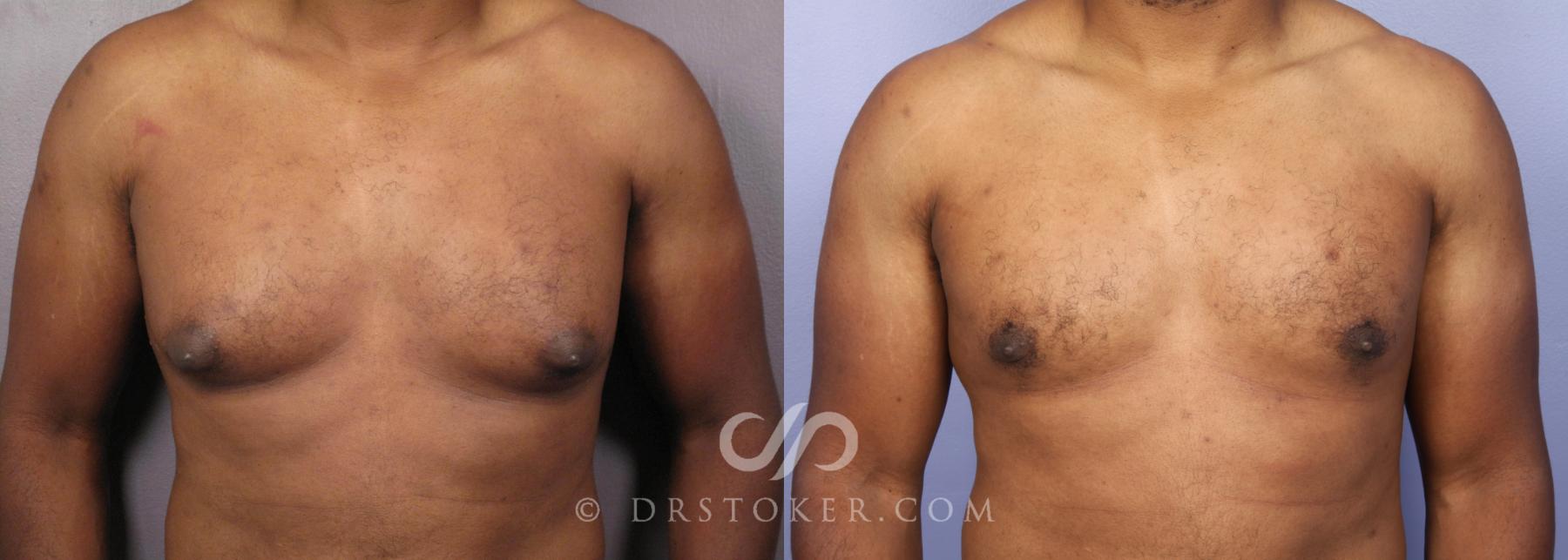 Before & After Breast Reduction for Men (Gynecomastia) Case 475 View #1 View in Los Angeles, CA