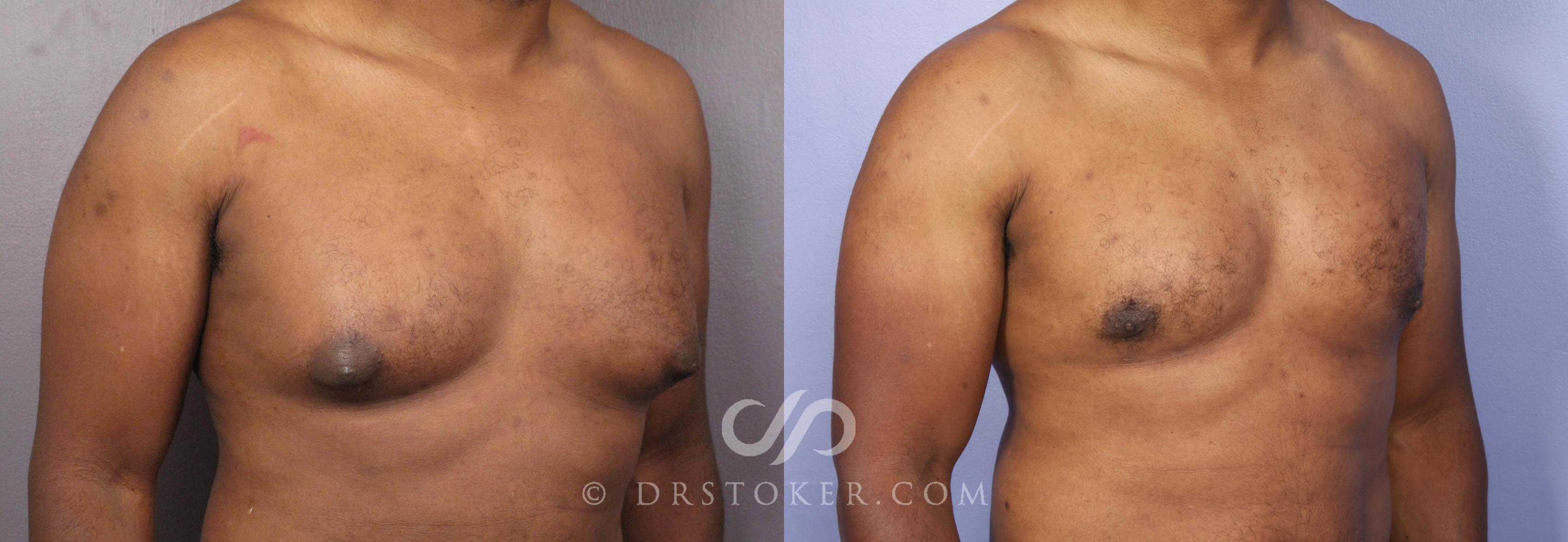 Before & After Breast Reduction (for Men) Case 475 View #2 View in Los Angeles, CA
