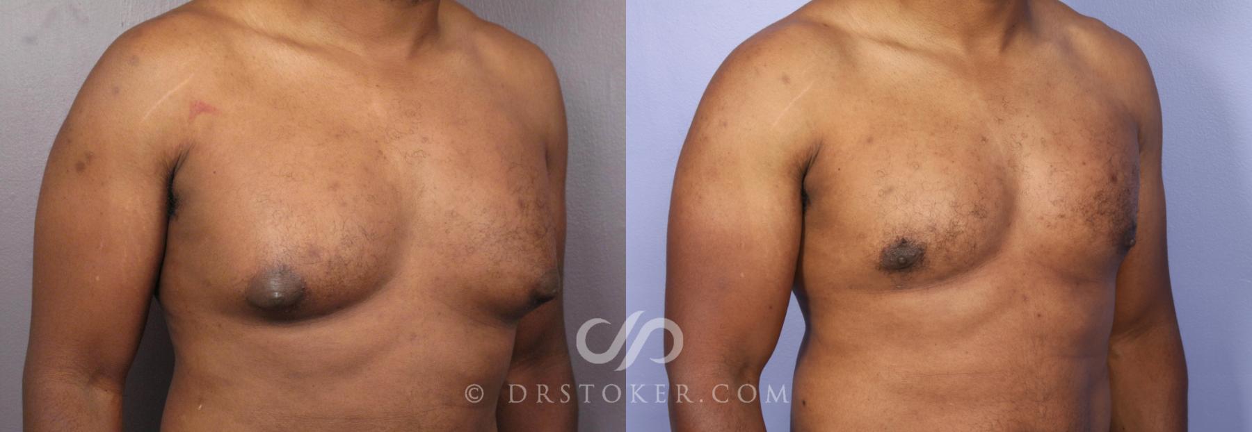Before & After Liposuction Case 475 View #2 View in Los Angeles, CA