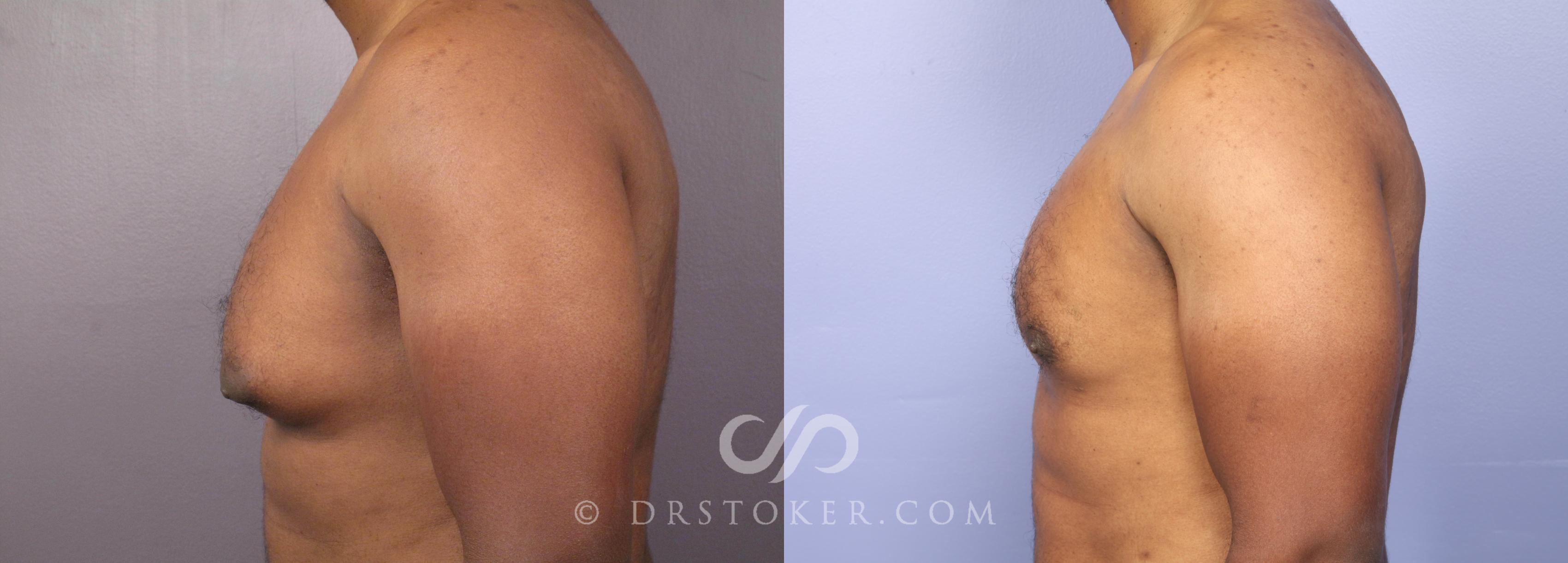 Before & After Breast Reduction (for Men) Case 475 View #5 View in Los Angeles, CA