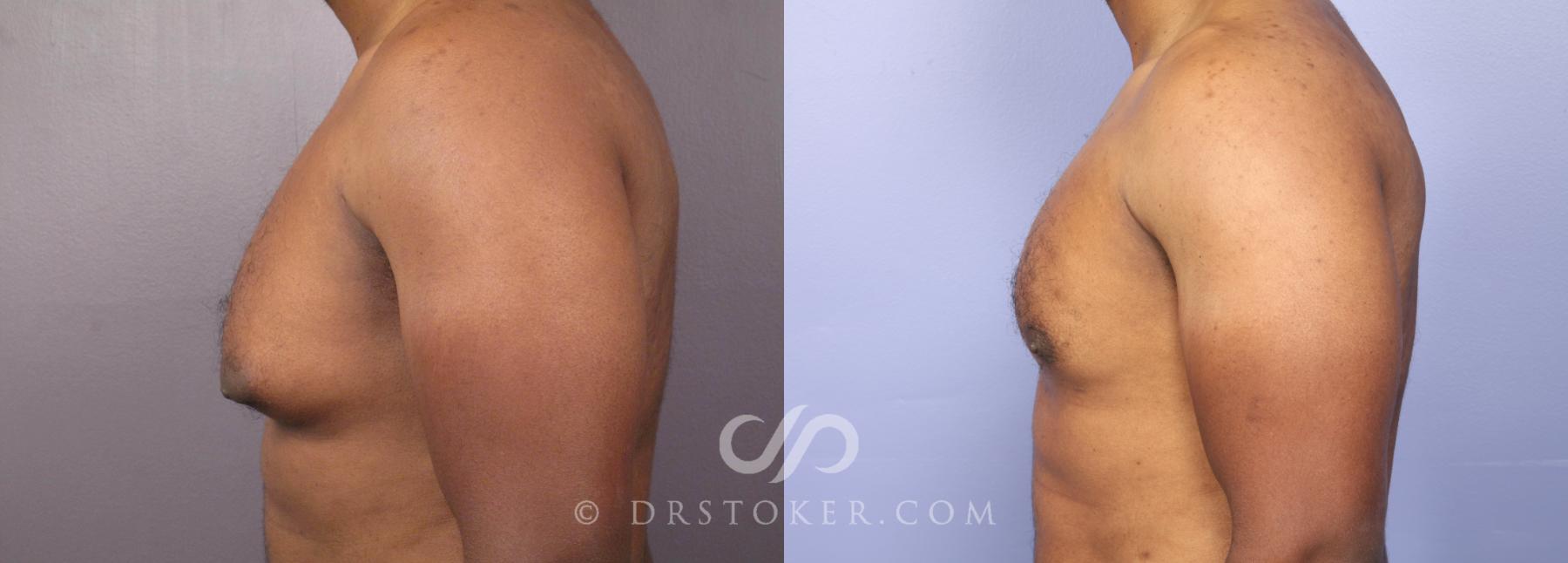 Before & After Breast Reduction for Men (Gynecomastia) Case 475 View #5 View in Los Angeles, CA
