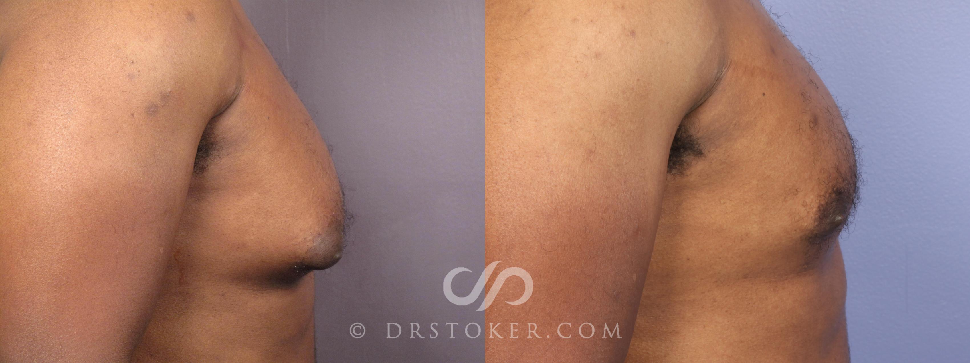 Before & After Breast Reduction (for Men) Case 475 View #6 View in Los Angeles, CA