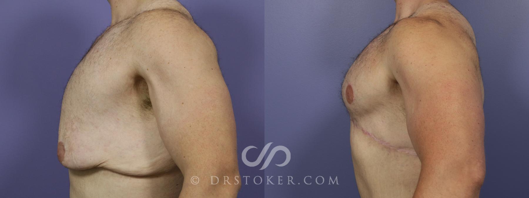 Before & After Breast Reduction for Men (Gynecomastia) Case 723 View #2 View in Los Angeles, CA