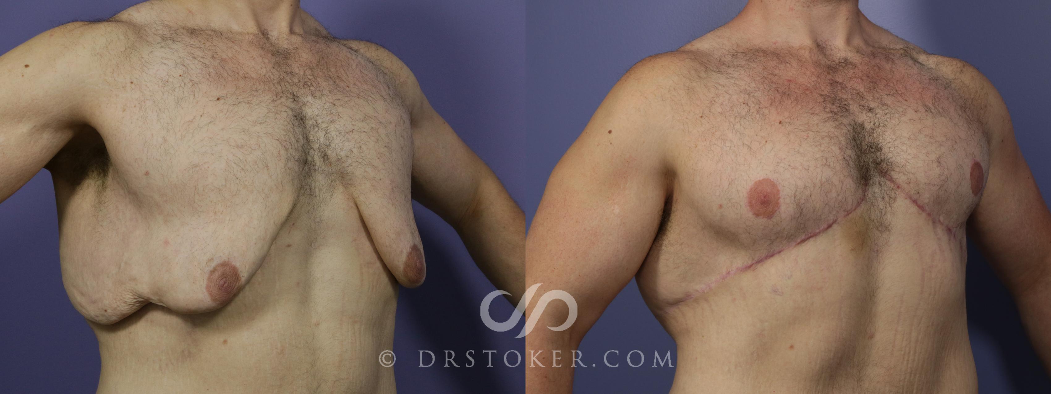 Before & After Breast Reduction for Men (Gynecomastia) Case 776 View #1 View in Marina del Rey, CA