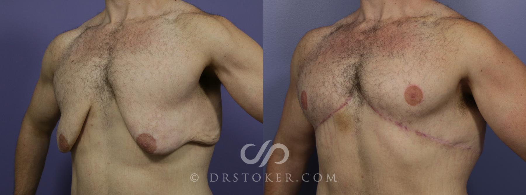 Before & After Breast Reduction for Men (Gynecomastia) Case 776 View #2 View in Los Angeles, CA