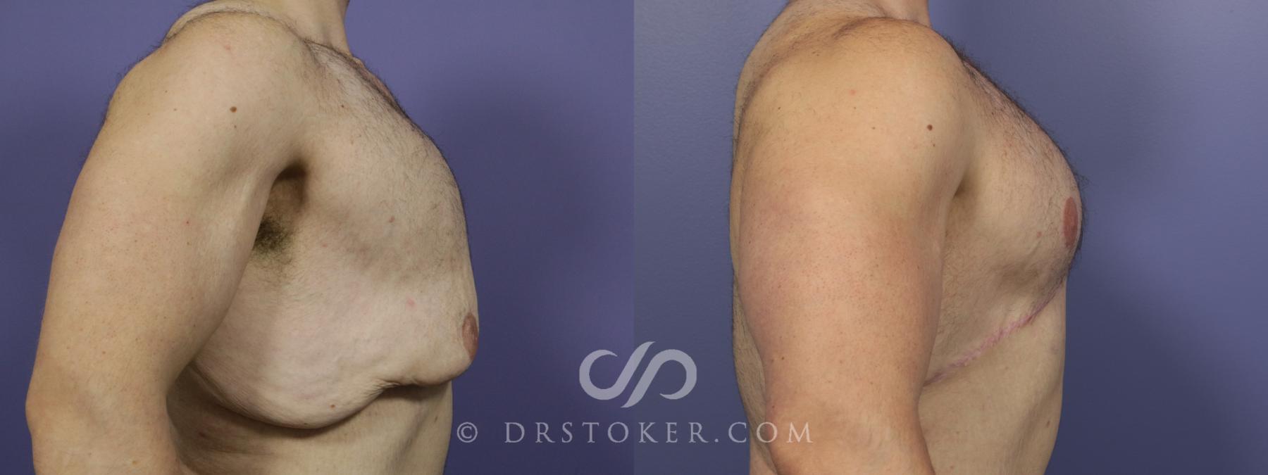 Before & After Breast Reduction for Men (Gynecomastia) Case 776 View #3 View in Los Angeles, CA