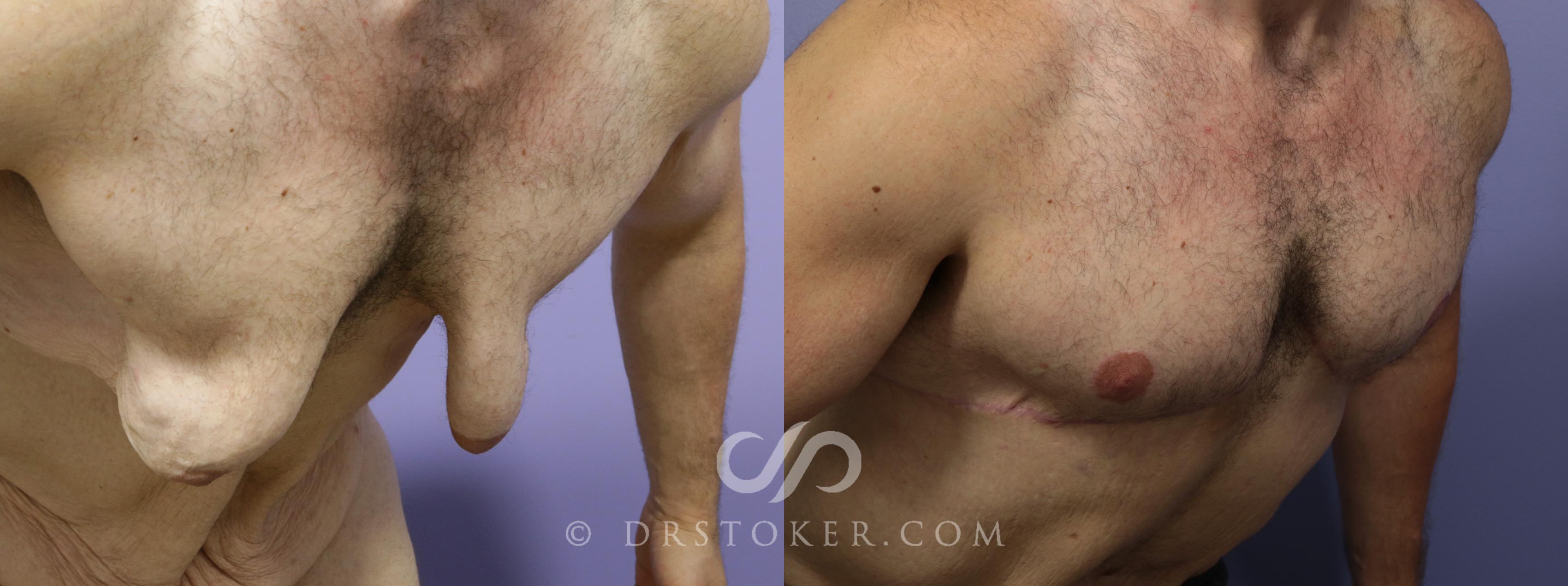 Before & After Breast Reduction for Men (Gynecomastia) Case 778 View #1 View in Marina del Rey, CA