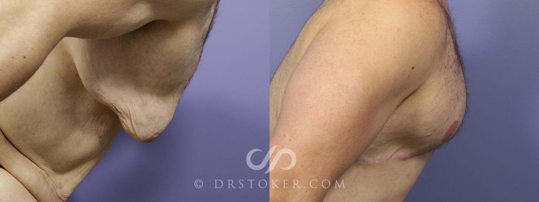 Before & After Breast Reduction for Men (Gynecomastia) Case 778 View #2 View in Los Angeles, CA