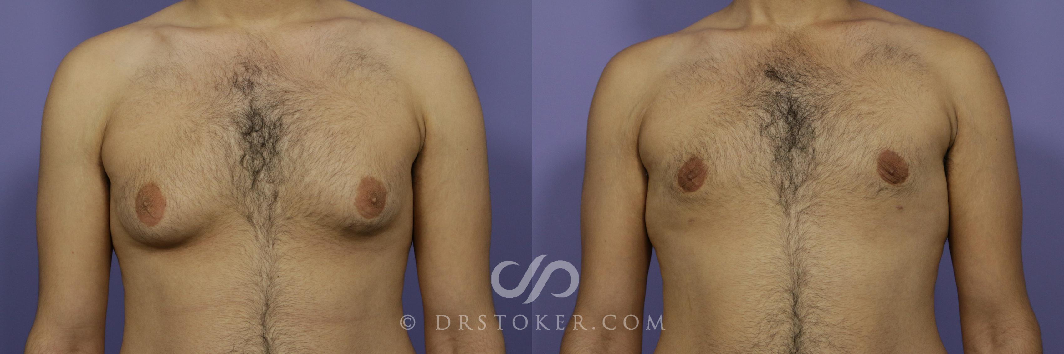 Before & After Breast Reduction (for Men) Case 780 View #1 View in Los Angeles, CA